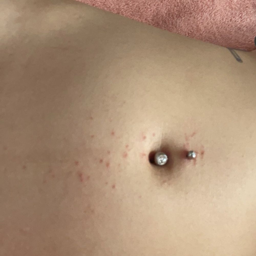 allergic reaction allergic reaction