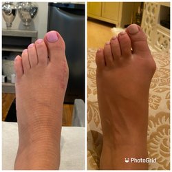 Al Ghamgosar, DPM - Peninsula Foot & Ankle Center - The right is my before and left is just 6 weeks after surgery