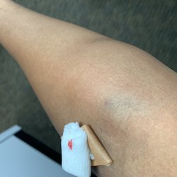 Dugas Jeffrey, MD - Arm after Dr. Jeff Dugas drew blood himself.