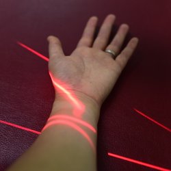 In Health Clinic - The Erchonia Fx 405 laser can be used on the extremities as well.