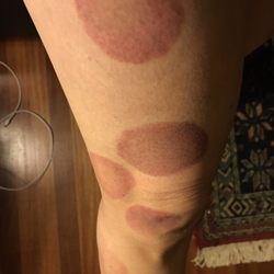Fu Jian Traditional Chinese Medical Center - Cupping results due to knee pain