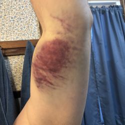 Biolife Plasma - Bruise