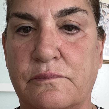 Jhonny Salomon - Before - Cosmetic Surgeons Near Me - Miami, Florida Jhonny Salomon - Before - Cosmetic Surgeons Near Me - Miami, Florida