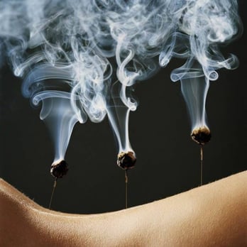 Open City Healing Arts - Moxa to warm the needles. - Psychologists Near Me - Philadelphia, Pennsylvania Open City Healing Arts - Moxa to warm the needles. - Psychologists Near Me - Philadelphia, Pennsylvania