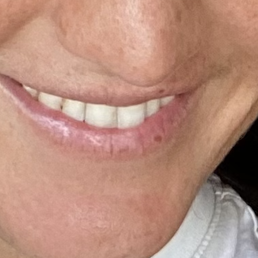 chipped tooth filling before. chipped tooth filling before.