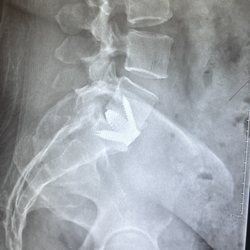 Ruiz Family Physicians - My fusion in L5 S1