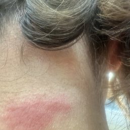 This is a burn mark from a hairstylist name Angela trying to shave the back of my neck. This is a burn mark from a hairstylist name Angela trying to shave the back of my neck.