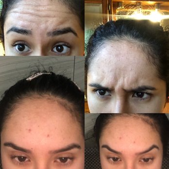 DermFx - After xeomin treatment 1 week later . I love !! - Medical Spas Near Me - Orange, California DermFx - After xeomin treatment 1 week later . I love !! - Medical Spas Near Me - Orange, California