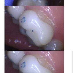 Farwest Dental Group - Photos taken by another dental office as proof of botched work