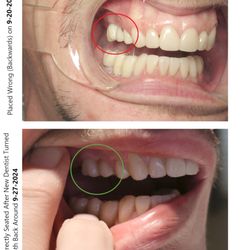 West Michigan Dist Dental Society - Tooth Number 3 Placed Backwards And Left For A Whole Year