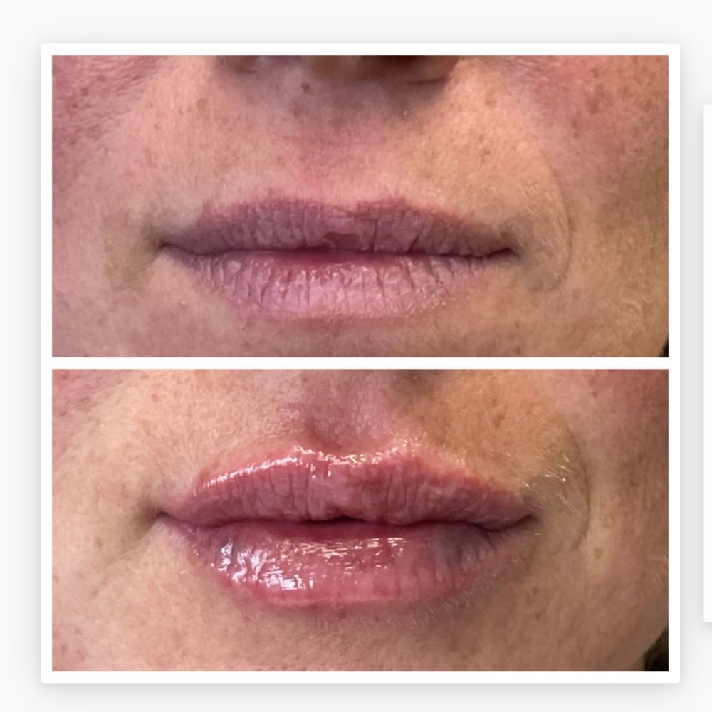BioSpa - Kat is a master injector! Love my new lips. She comforted me and helped me feel at ease. Only person I'll let touch mine - Medical Spas Near Me - Newport Beach, California BioSpa - Kat is a master injector! Love my new lips. She comforted me and helped me feel at ease. Only person I'll let touch mine - Medical Spas Near Me - Newport Beach, California
