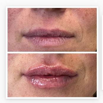 BioSpa - Kat is a master injector! Love my new lips. She comforted me and helped me feel at ease. Only person I'll let touch mine - Medical Spas Near Me - Newport Beach, California BioSpa - Kat is a master injector! Love my new lips. She comforted me and helped me feel at ease. Only person I'll let touch mine - Medical Spas Near Me - Newport Beach, California