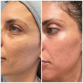 CynSational Aesthetics - Say hello to smoother, brighter, more youthful skin with microneedling at CynSational Aesthetics - Medical Spas Near Me - Folsom, California CynSational Aesthetics - Say hello to smoother, brighter, more youthful skin with microneedling at CynSational Aesthetics - Medical Spas Near Me - Folsom, California