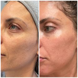 CynSational Aesthetics - Say hello to smoother, brighter, more youthful skin with microneedling at CynSational Aesthetics