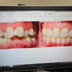 Lakewood Orthodontics - Incredible difference from the beginning of this journey to now. Bitter sweet ending. Amazed at how much my smile has changed!