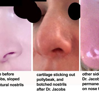 The Jacobs Center for Cosmetic Surgery - Before nose with my slope and beautiful natural nostrils, and two views of after rhinoplasty showing multiple unsightly defects. - Cosmetic Surgeons Near Me - Healdsburg, California The Jacobs Center for Cosmetic Surgery - Before nose with my slope and beautiful natural nostrils, and two views of after rhinoplasty showing multiple unsightly defects. - Cosmetic Surgeons Near Me - Healdsburg, California