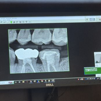 Rancho San Diego Dentists - New crown from new dentist (left) crown from Rancho SD (right) - General Dentistry Near Me - La Mesa, California Rancho San Diego Dentists - New crown from new dentist (left) crown from Rancho SD (right) - General Dentistry Near Me - La Mesa, California