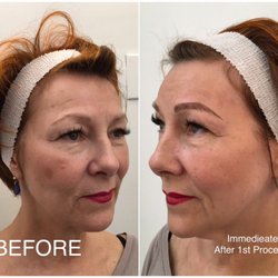 Eyebrowbaby Microblading + Beauty - Restored eyebrows for a lovely lady!