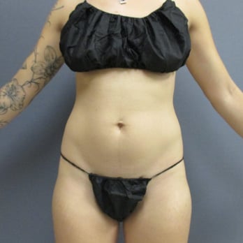 North Coast Plastic Surgery - pre op photo of abdomen and hips - Skin Care Near Me - Oceanside, California North Coast Plastic Surgery - pre op photo of abdomen and hips - Skin Care Near Me - Oceanside, California