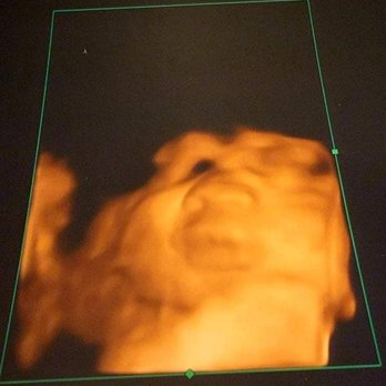 Next Generation Prenatal Imaging - Ultrasound Imaging Centers Near Me - Elk Grove, California Next Generation Prenatal Imaging - Ultrasound Imaging Centers Near Me - Elk Grove, California