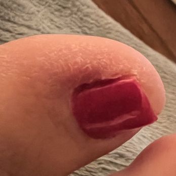 Foxy Nails - Infected toenail - Nail Salons Near Me - Happy Valley, Oregon
