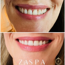 ZaSpa - Before & After Gummy line tox treatment