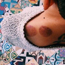 Deeper Genius Acupuncture & Healing Arts - Client photo of cupping marks. She's feeling much better!