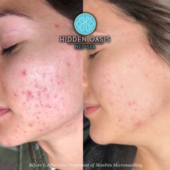Hidden Hills Med Spa - Microneedling SkinPen Acne Treatment - Medical Spas Near Me - Helotes, Texas Hidden Hills Med Spa - Microneedling SkinPen Acne Treatment - Medical Spas Near Me - Helotes, Texas