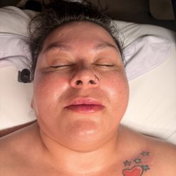 After the Botox facial