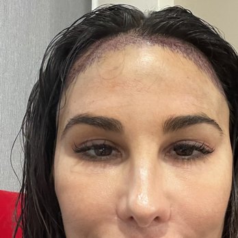 Jae Pak, M.D - Immediately after the procedure and was completed. So excited to see the process of the new hairs grow in . - Hair Loss Centers Near Me - Los Angeles, California