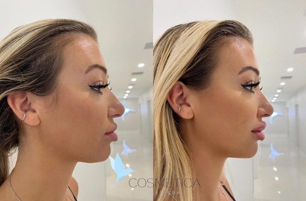 Lip Filler Injections - Lip augmentation is a type of procedure that aims to increase lip fullness through enlargement using fillers such as hyaluronic acid, fat, or implants.