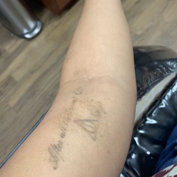 Removery Tattoo Removal & Fading - Progress. Right before session 5, about two months or so after session4. - Tattoo Removal Near Me - Vienna, Virginia Removery Tattoo Removal & Fading - Progress. Right before session 5, about two months or so after session4. - Tattoo Removal Near Me - Vienna, Virginia