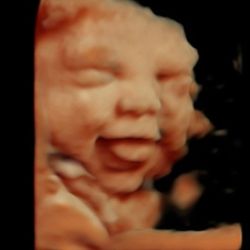 Miracle View 3D/4D Ultrasound
