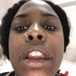 Hawthorne Family Dental Care - Wisdom tooth removal