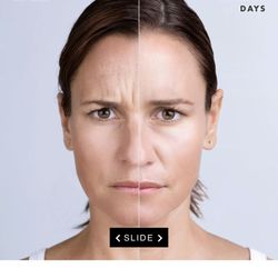 Elevated Direct Primary Care - Xeomin/Botox before and after