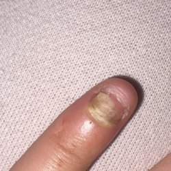 Pretty Nails - The infection in my finger