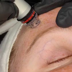 Bare Esthetics - Hydroderm facial