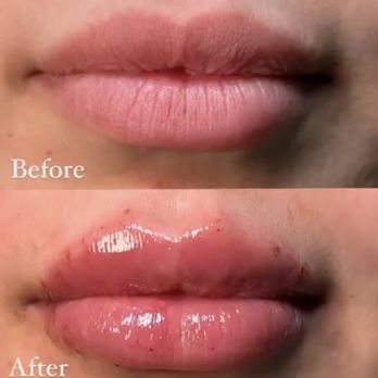 The Plastics Doc & Med Spa - Restylane Kiss lip filler - Plastic Surgeons Near Me - Corona, California The Plastics Doc & Med Spa - Restylane Kiss lip filler - Plastic Surgeons Near Me - Corona, California