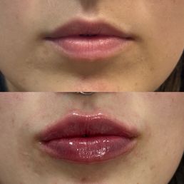Front View of Lips Before & After