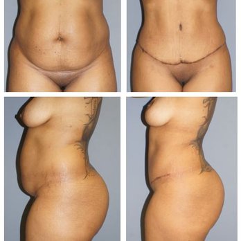 DAVinci Plastic Surgery - This patient is incredibly pleased with the results from her mommy makeover! (Abdominoplasty, liposuction, mastopexy, and fat grafting) - Cosmetic Surgeons Near Me - Washington, DC, District of Columbia