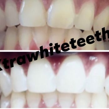 Gleamed By Chelle - Whitened - Teeth Whitening Near Me Gleamed By Chelle - Whitened - Teeth Whitening Near Me