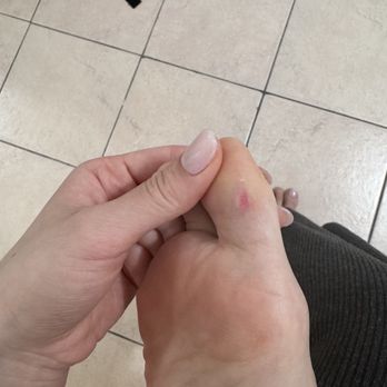 Cinderella Nail Spa - The cut they gave me after scrubbing so hard - Nail Salons Near Me - Flushing, New York Cinderella Nail Spa - The cut they gave me after scrubbing so hard - Nail Salons Near Me - Flushing, New York