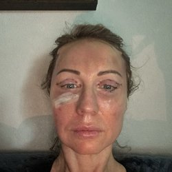 Day 1 Post Surgery
