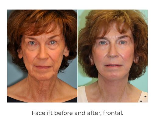 Facelift - Facelift Portfolio Facelift - Facelift Portfolio
