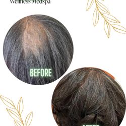 Believe Health and Wellness Medspa - Client came in for a problem area, stayed consistent and these were her amazing results!