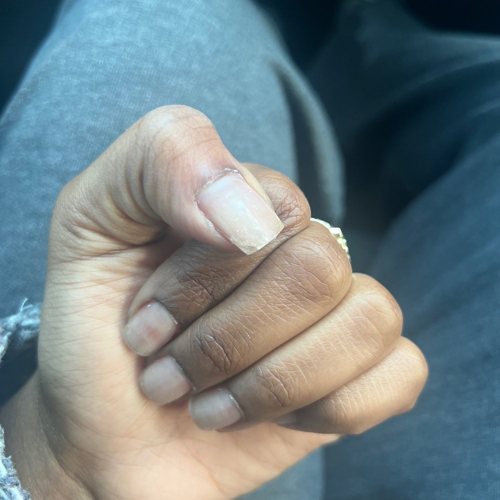Magic Nails - Cut on thumb too, and acrylic on my skin - Nail Salons Near Me - Hawthorne, California Magic Nails - Cut on thumb too, and acrylic on my skin - Nail Salons Near Me - Hawthorne, California