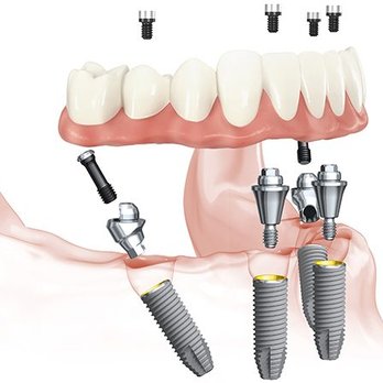 Specialists in Implant Dentistry - Teeth in a Day - Cosmetic Dentists Near Me - Naples, Florida Specialists in Implant Dentistry - Teeth in a Day - Cosmetic Dentists Near Me - Naples, Florida