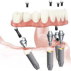 Specialists in Implant Dentistry - Teeth in a Day