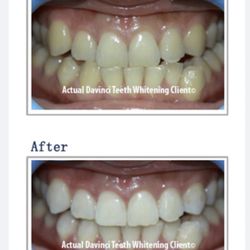 New Concepts Hair Salon - DaVinci Teeth
Whitening