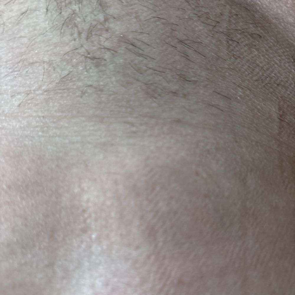 LaserAway - Over a year of laser removal and this is what I am left with - Laser Hair Removal Near Me - Carlsbad, California LaserAway - Over a year of laser removal and this is what I am left with - Laser Hair Removal Near Me - Carlsbad, California